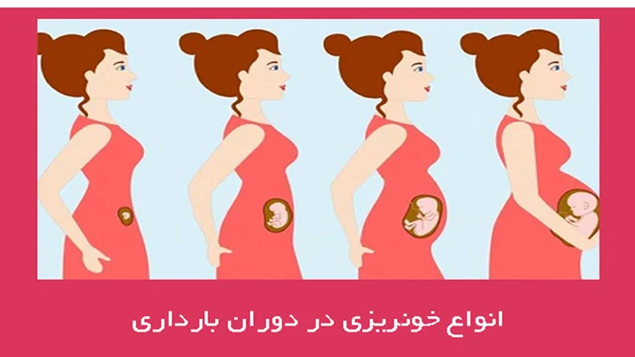 خونریزی در بارداری + آیا خونریزی رحم در بارداری خطرناک است؟