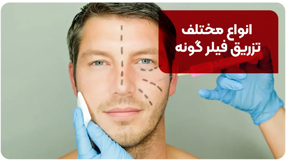 انواع مختلف تزریق فیلر گونه