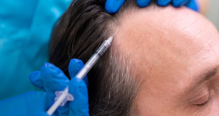 هیر فیلر مو چیست؟